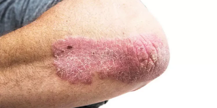 സോറിയാസിസ്;-കാരണമറിയാം