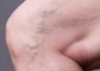 ഞരമ്പു-വീക്കത്തിന്-കാരണങ്ങള്‍…